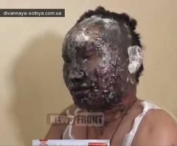 Картинки по запросу обожженный танкист бурят донбасс фото