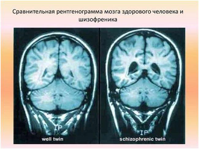 Диагностика шизофрении по картинкам