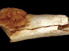 Обнаружена самая древняя раковая опухоль у людей